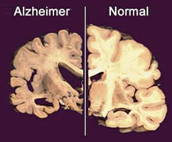 (Fig.15.) En aquesta imatge es pot comparar entre un cervell deteriorat per l’alzheimer i un altre en bon estat